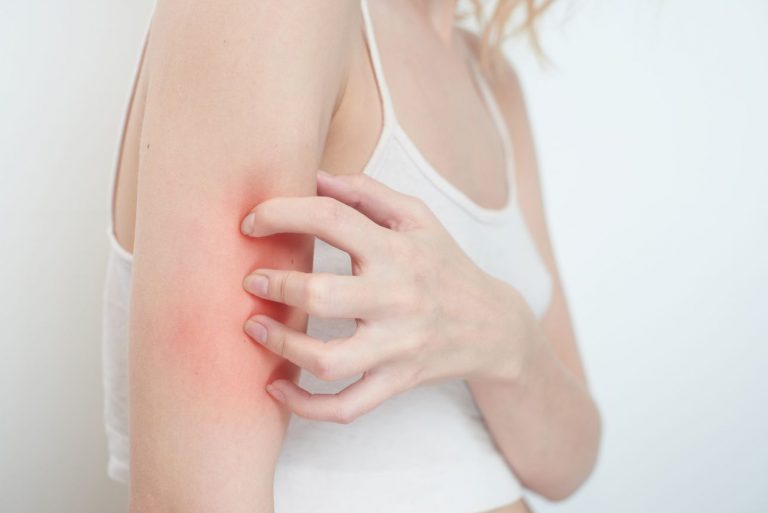 Winter Itch/Dry Skin