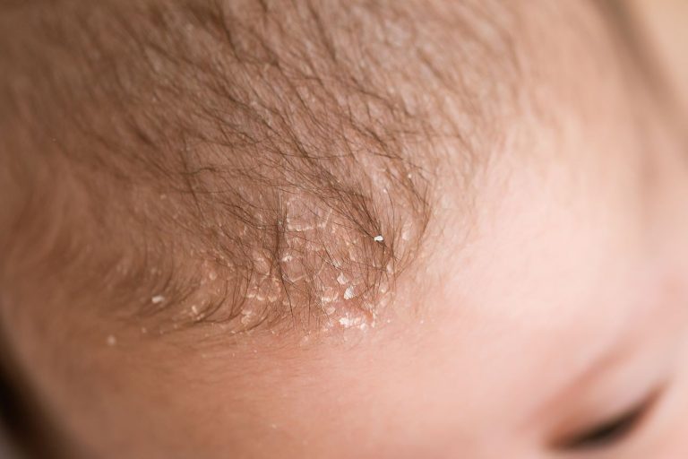 Seborrheic Dermatitis