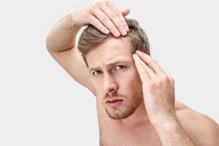 Alopecia