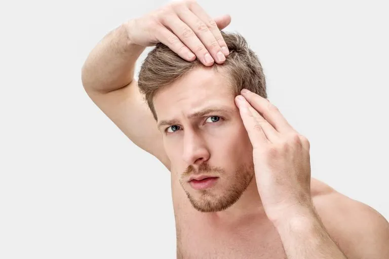 Alopecia