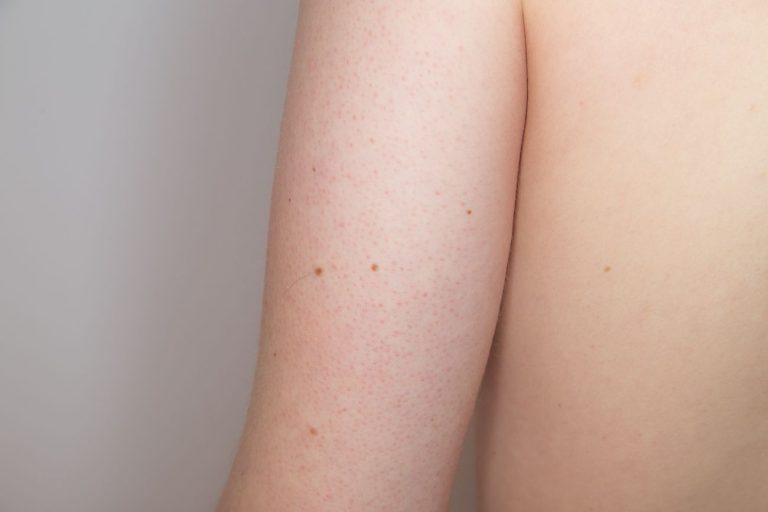 Keratosis Pilaris