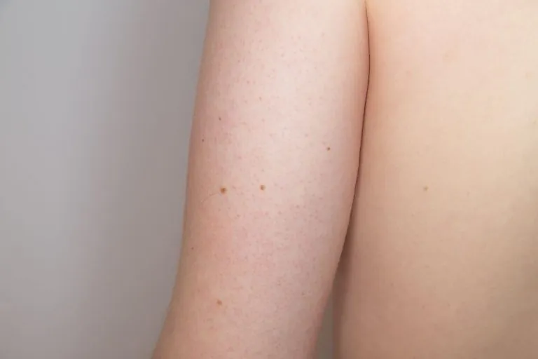Keratosis Pilaris