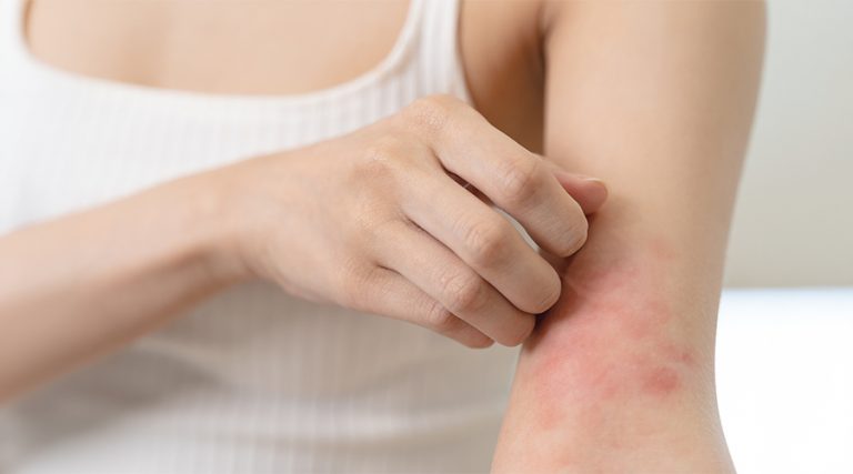 Eczema