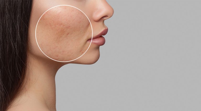 Hyperpigmentation