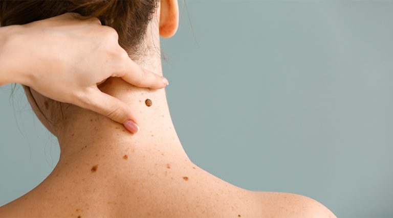 Mole Removal
