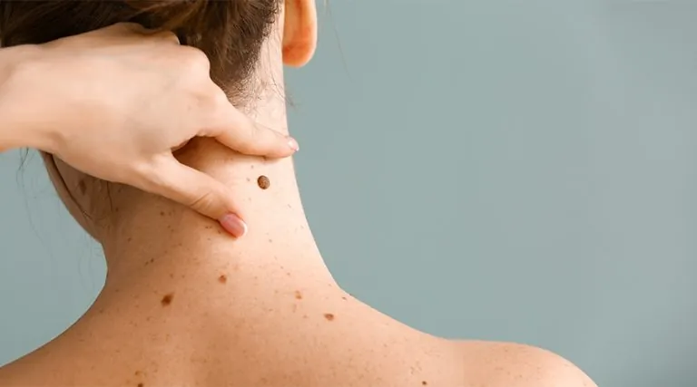 Mole Removal