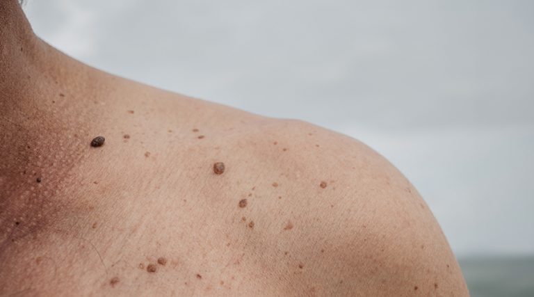 Moles