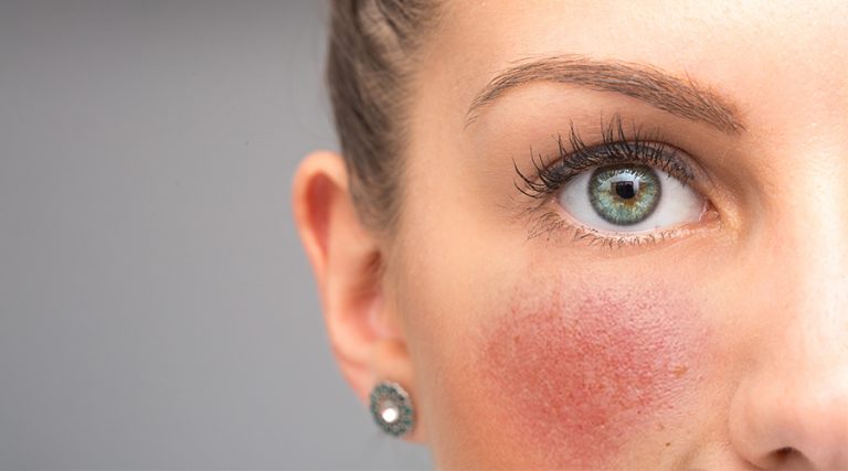 Rosacea