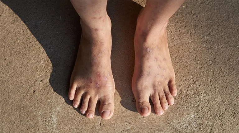 Stasis Dermatitis