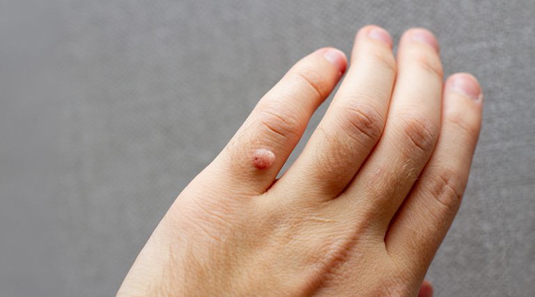 Warts