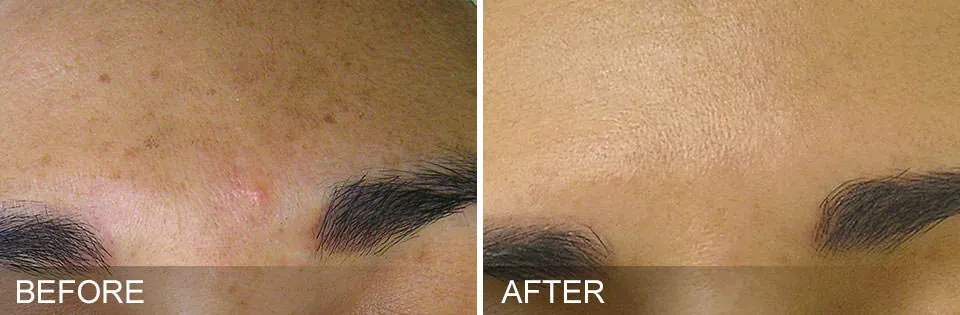 Before and after HydraFacial treatments