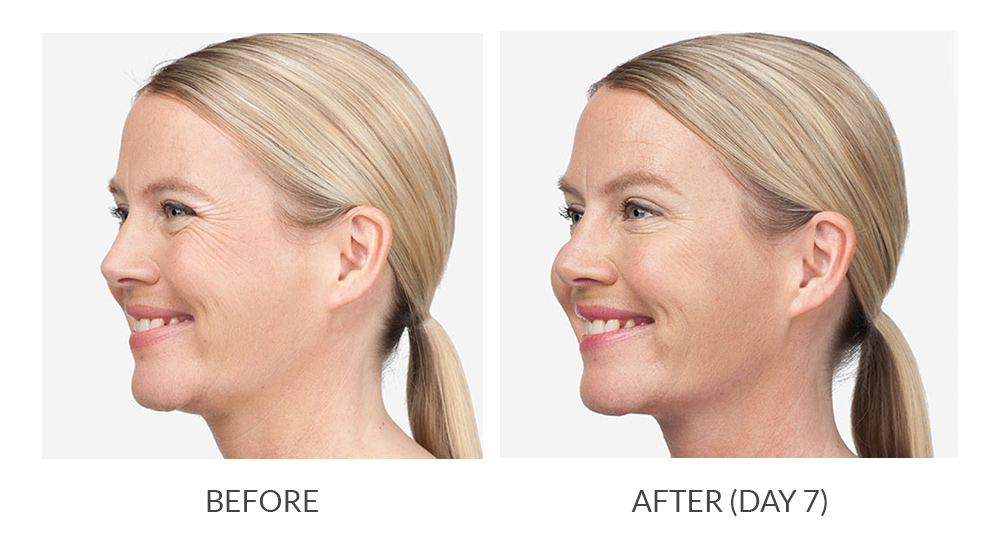 Before and after Botox Cosmetic results