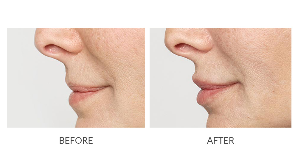 Before and after Restylane results