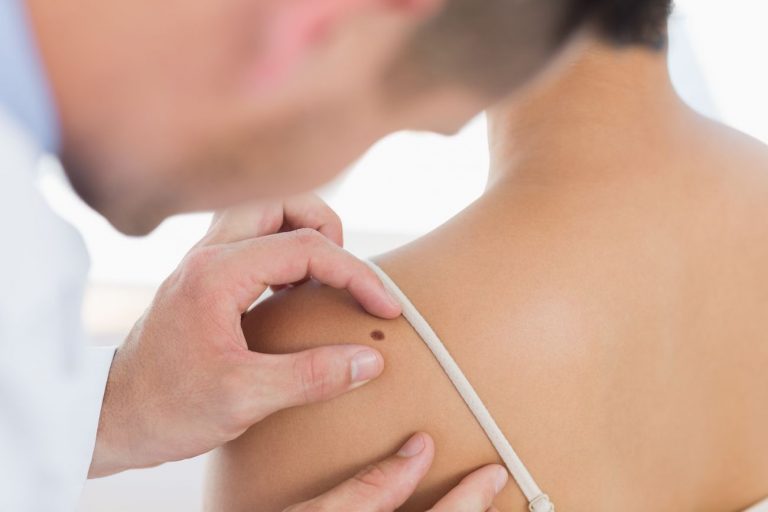 Skin Cancer