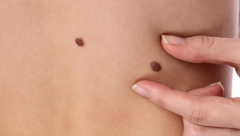 Skin Tag Removal