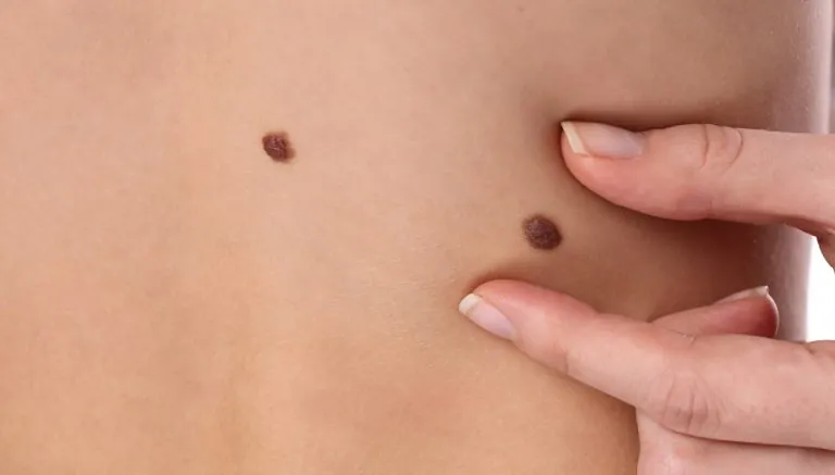 Skin Tag Removal