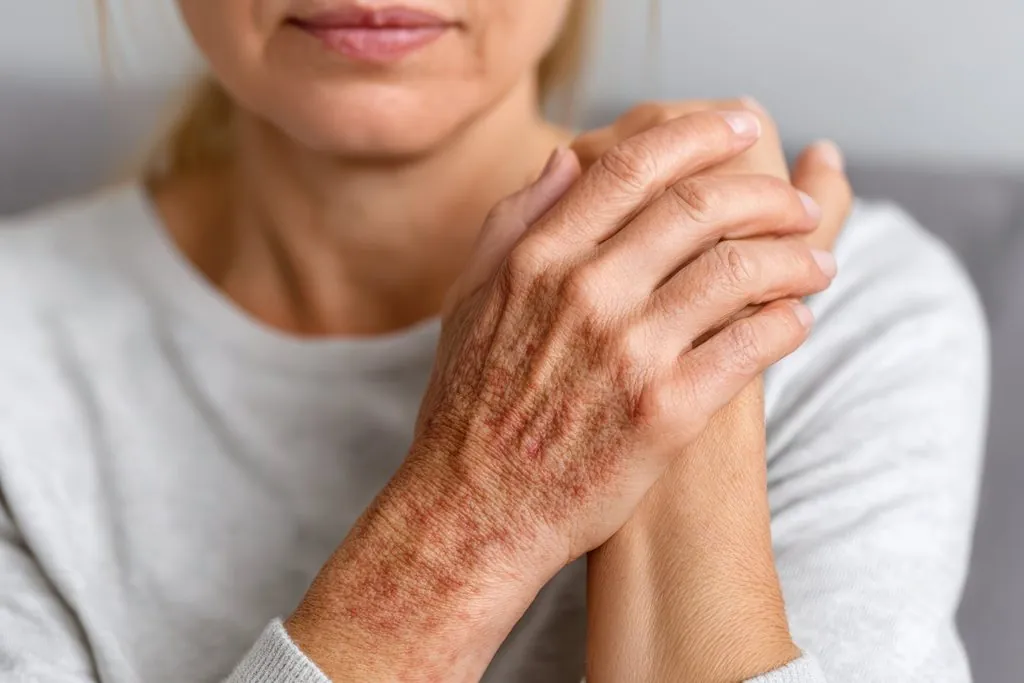 Older woman's hand and wrist with blotchy red-brown discoloration on sun-damaged skin