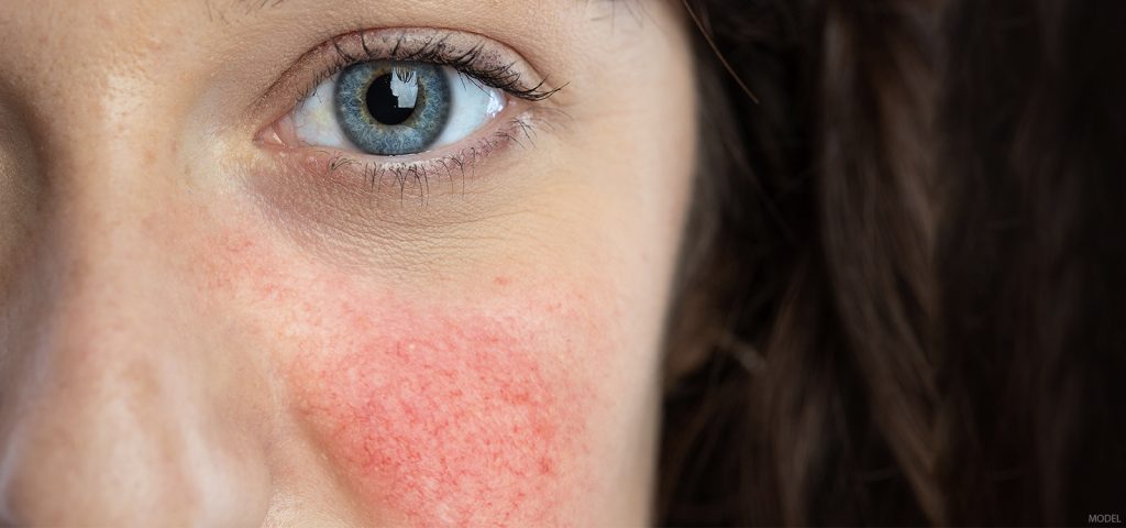 The Facts About Rosacea
