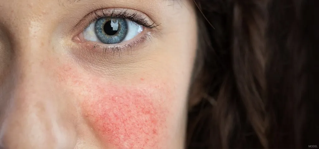 The Facts About Rosacea