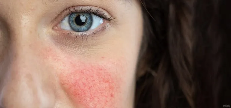 The Facts About Rosacea