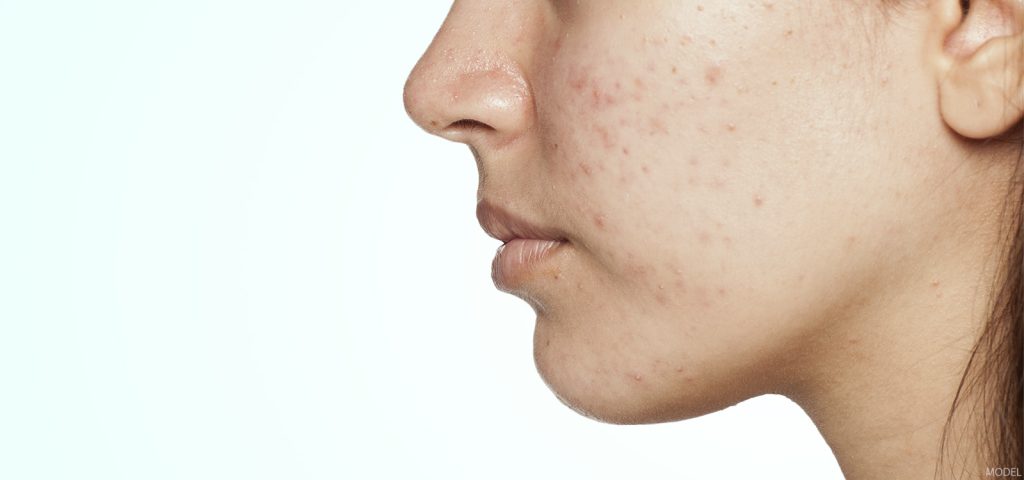 Acne Fact or Fiction
