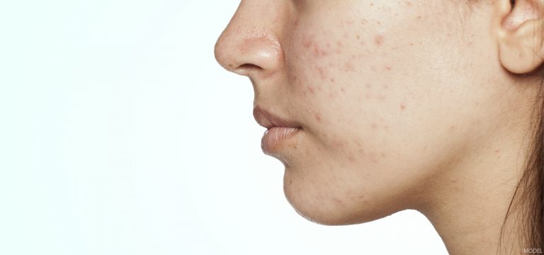 Acne: Fact or Fiction?