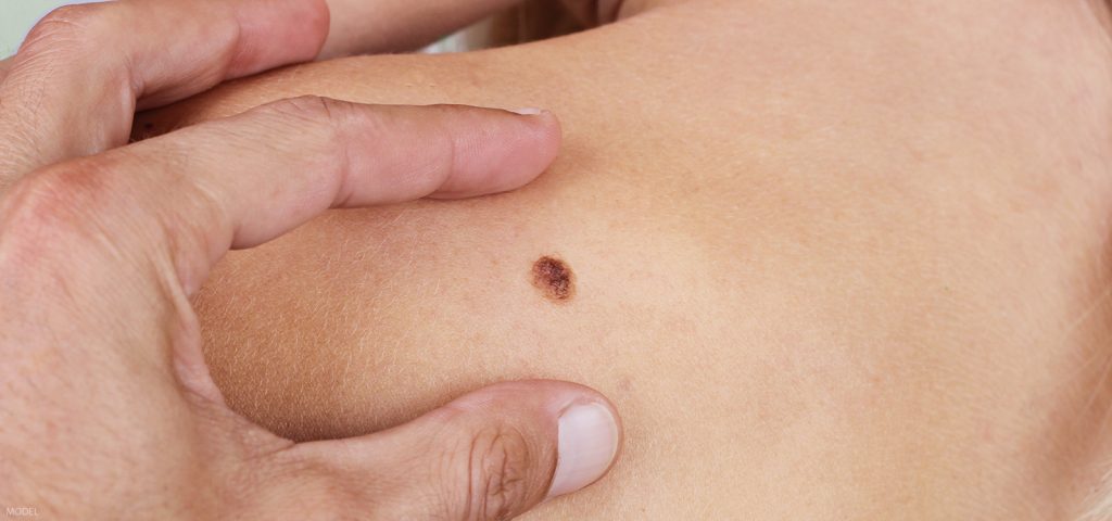 Mole skin check