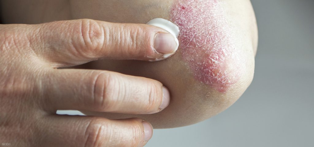 Psoriasis Not Just Dry Skin