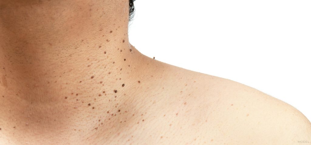 Man with skin growths on the neck