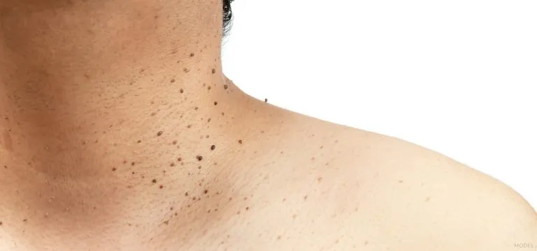 What You Need To Know About Skin Growths