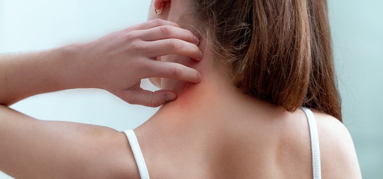 5 Things to Know About Eczema