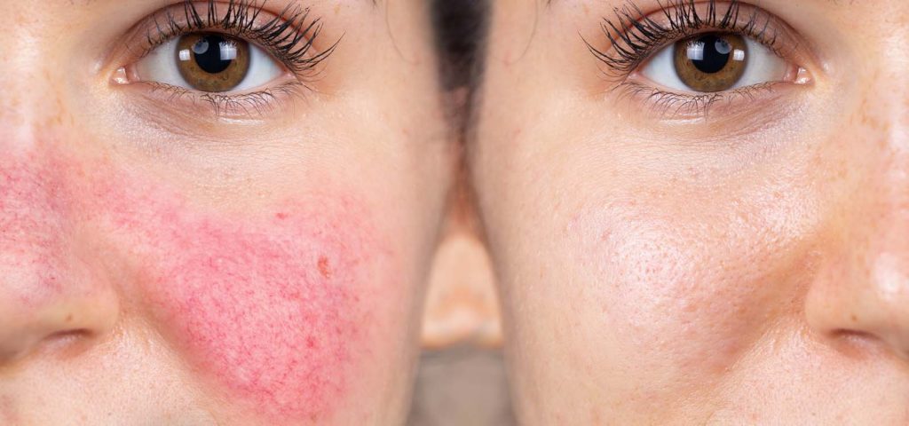 Woman with rosacea before and after