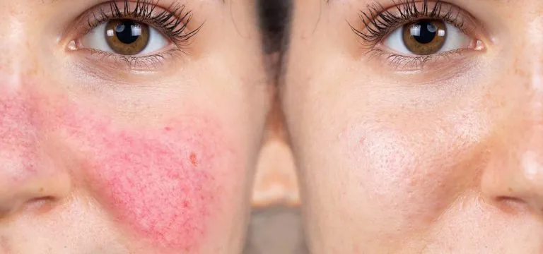 Understanding and Treating Rosacea