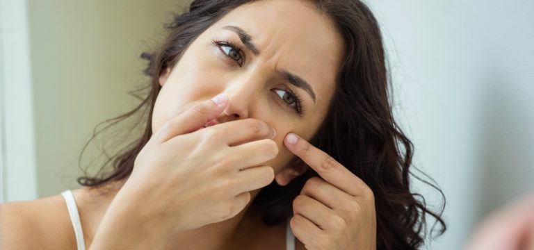 5 Ways To Treat Adult Acne
