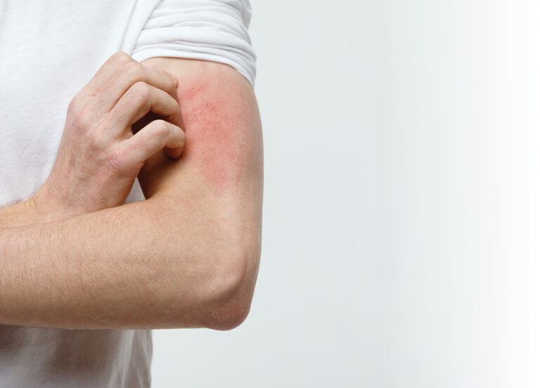 7 Eczema Triggers You Need To Be Aware Of 
