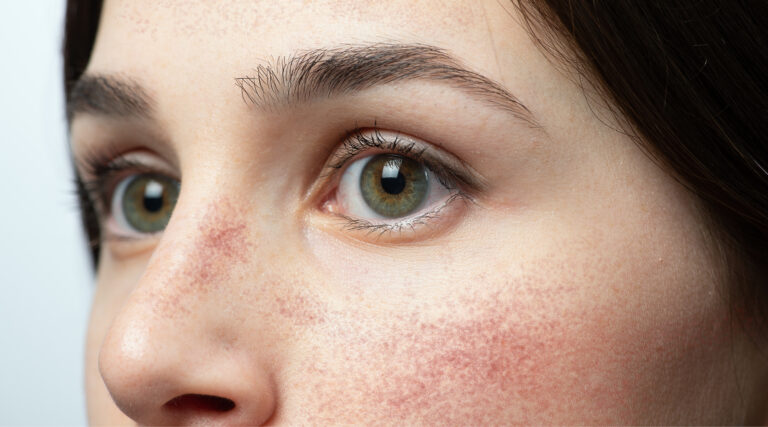 Demystifying 3 Common Rosacea Myths 