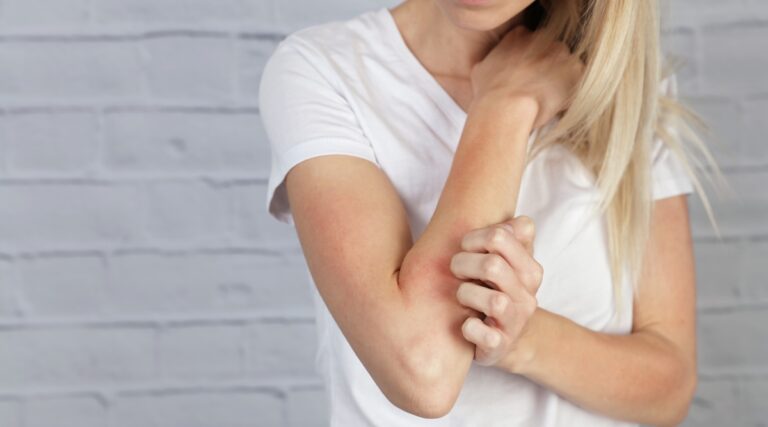 How To Navigate Eczema With Confidence This Fall