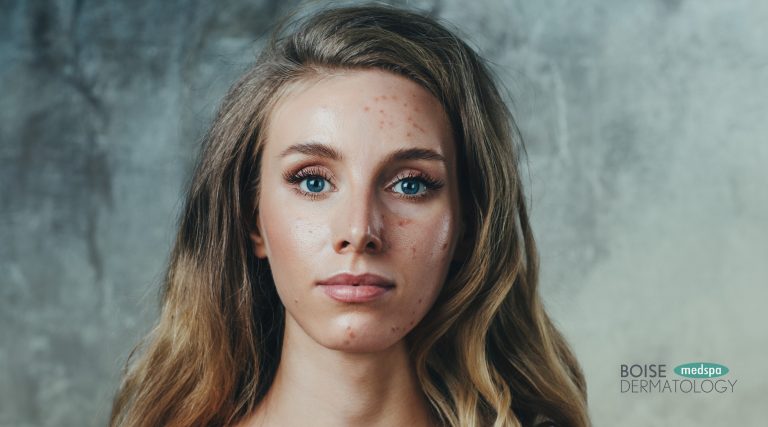 Is Summer Making Your Acne Worse? Here’s What to Do About It